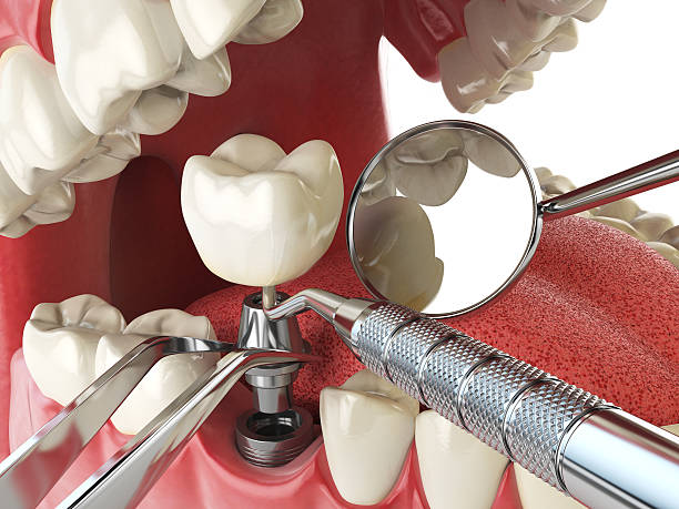 Best Emergency Tooth Extraction in Mcnair, VA